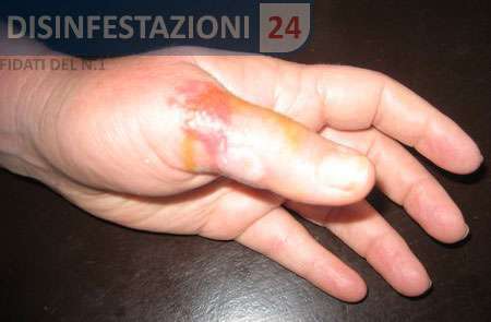 calabrone nero puntura