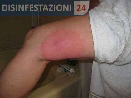 puntura scorpione
