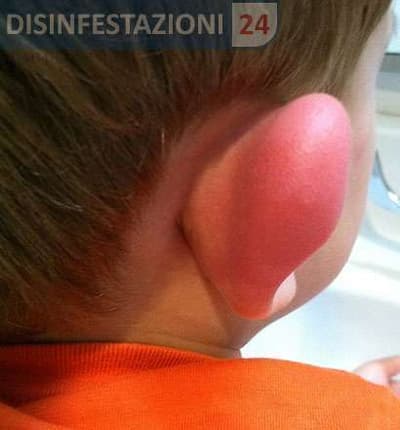 reazione allergica alla puntura della zanzara